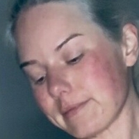 kaepiglet Alaston